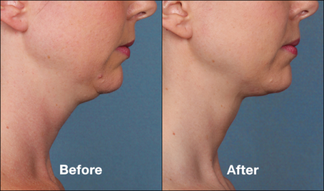 Beverly Hills Center Female Patient Before and After Chin Kybella Injections Treatment
