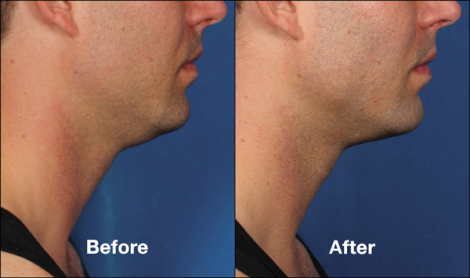 Beverly Hills Center Male Patient Before and After Chin Kybella Injections Treatment