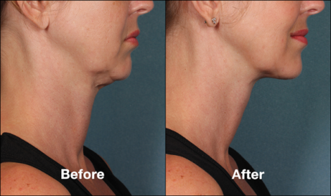 Beverly Hills Center Female Patient Before and After Chin Kybella Injections Treatment