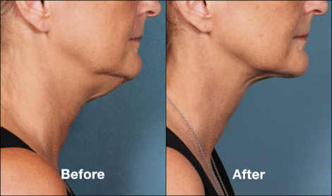 Beverly Hills Center Female Patient Before and After Chin Kybella Injections Treatment