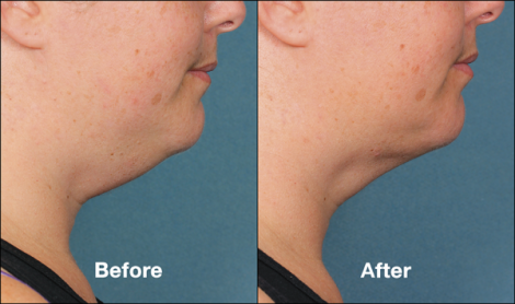 Beverly Hills Center Female Patient Before and After Chin Kybella Injections Treatment