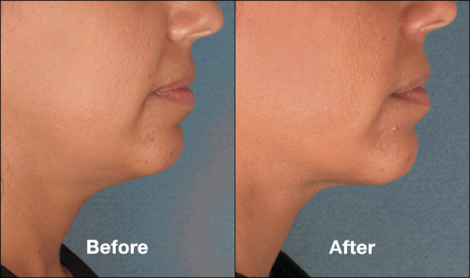 Beverly Hills Center Patient Before and After Chin Kybella Injections Treatment