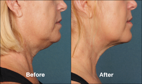 Beverly Hills Center Female Patient Before and After Chin Kybella Injections Treatment
