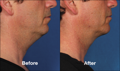 Beverly Hills Center Male Patient Before and After Chin Kybella Injections Treatment