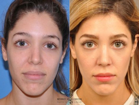 Beverly Hills Center Female Patient Before and After Natural Rhinoplasty Procedure