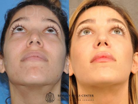 Beverly Hills Center Female Patient Before and After Natural Rhinoplasty Procedure