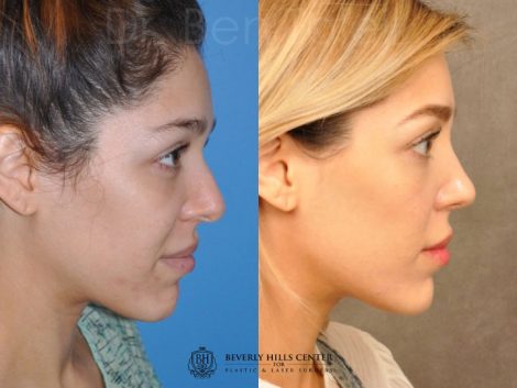 Beverly Hills Center Female Patient Before and After Natural Rhinoplasty Procedure