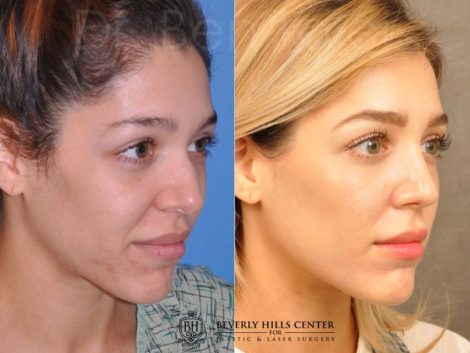 Beverly Hills Center Female Patient Before and After Natural Rhinoplasty Procedure