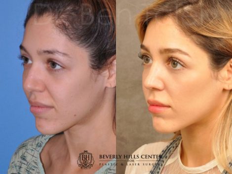 Beverly Hills Center Female Patient Before and After Natural Rhinoplasty Procedure