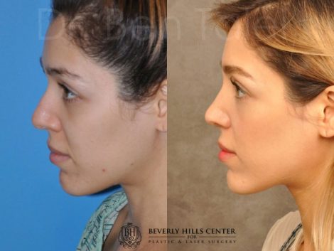 Beverly Hills Center Female Patient Before and After Natural Rhinoplasty Procedure