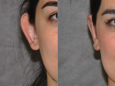 Otoplasty (Ear Pinning and Reshaping)