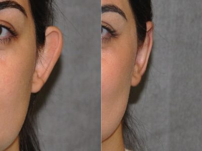 Otoplasty (Ear Pinning and Reshaping)