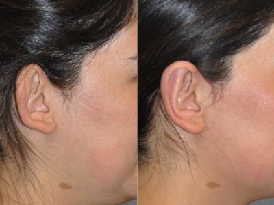Otoplasty (Ear Pinning and Reshaping)