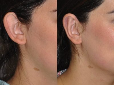 Otoplasty (Ear Pinning and Reshaping)
