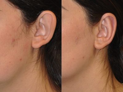 Otoplasty (Ear Pinning and Reshaping)