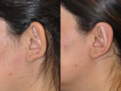 Otoplasty (Ear Pinning and Reshaping)