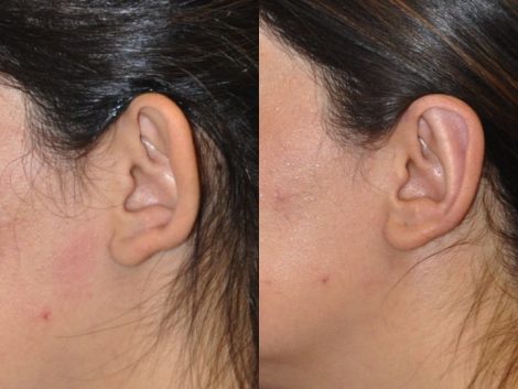 Otoplasty (Ear Pinning and Reshaping)