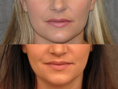 Modified Upper Lip lift for character – Front