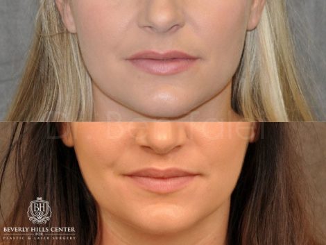 Modified Upper Lip lift for character – Front