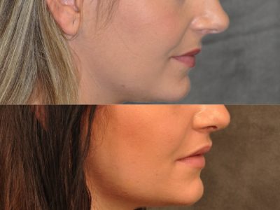 Modified Upper Lip lift for character – Right Side