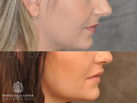 Modified Upper Lip lift for character – Right Side