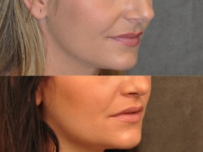 Modified Upper Lip lift for character – Right Side