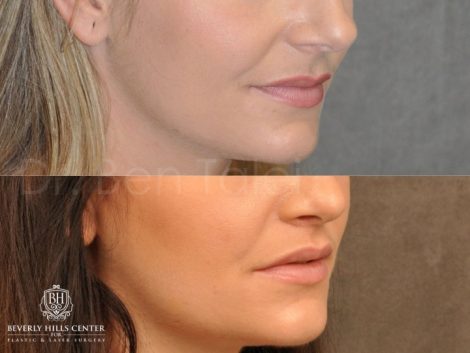 Modified Upper Lip lift for character – Right Side