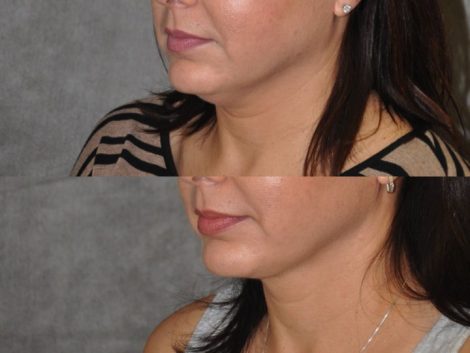 MicroLiposuction of the Neck and Chin - Left Side