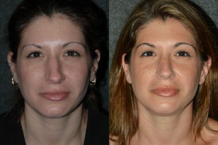 Minimally Invasive (Closed) REVISION Rhinoplasty - Front