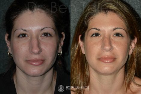 Minimally Invasive (Closed) REVISION Rhinoplasty - Front