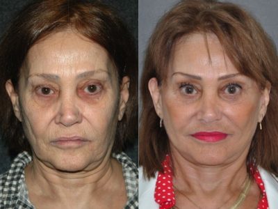 Revision Face and Neck Lift - Front