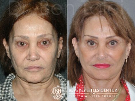 REVISION Face and Neck Lift - Front