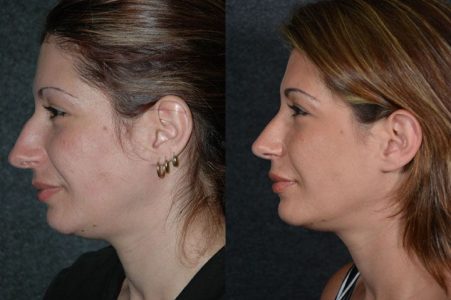 Minimally Invasive (Closed)REVISION Rhinoplasty - Left Side