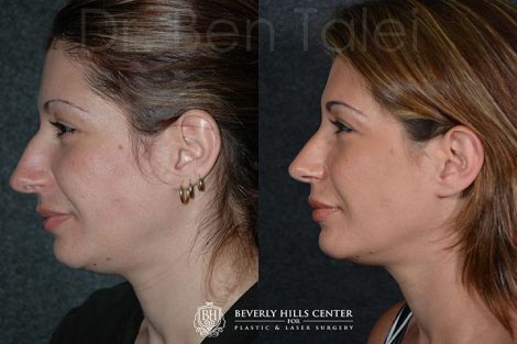 Minimally Invasive (Closed)REVISION Rhinoplasty - Left Side