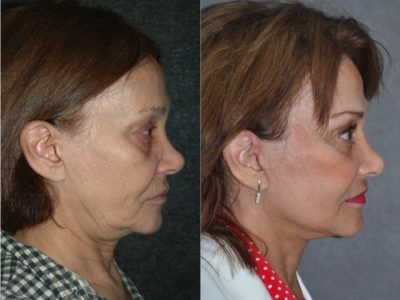 Revision Face and Neck Lift - Right Side