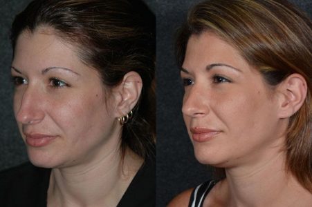 Minimally Invasive (Closed)REVISION Rhinoplasty - Left Side
