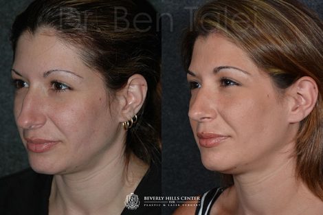 Minimally Invasive (Closed)REVISION Rhinoplasty - Left Side