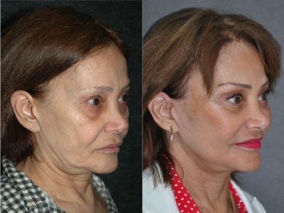 Revision Face and Neck Lift - Right Side