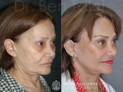 REVISION Face and Neck Lift - Right Side