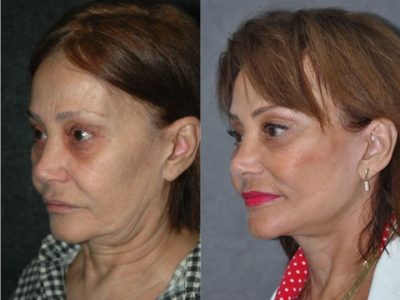 Revision Face and Neck Lift - Left Side