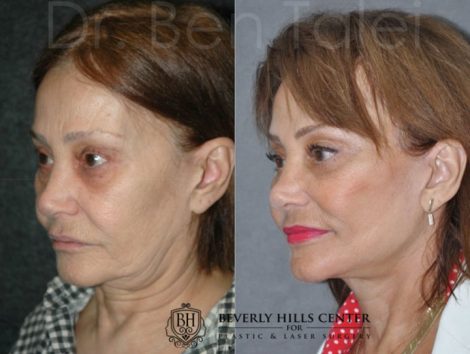 REVISION Face and Neck Lift - Left Side