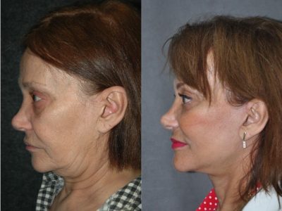 Revision Face and Neck Lift - Left Side