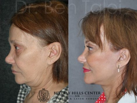 REVISION Face and Neck Lift - Left Side