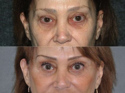 Revision Face and Neck Lift - Front