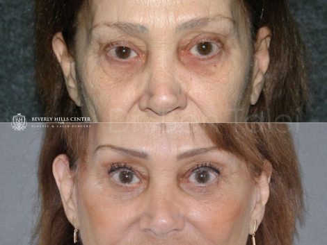Lower Eyelid Rejuvenation - Front