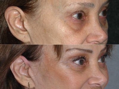 Lower Eyelid Rejuvenation - Right Side