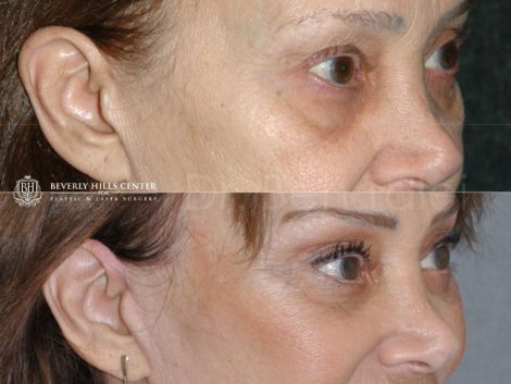 Lower Eyelid Rejuvenation - Right Side