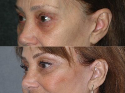 Lower Eyelid Rejuvenation - Left Side