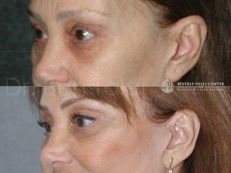 Lower Eyelid Rejuvenation - Left Side