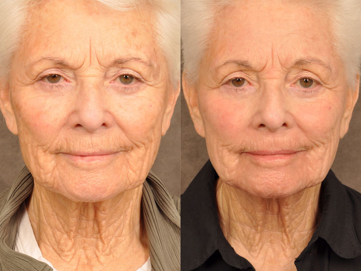 Laser Facelift / Profound MicroLift Before & Afters Beverly Hills